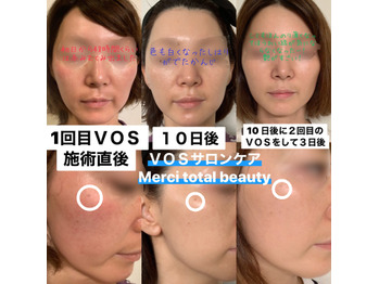 VOSサロンケア始めました | Merci total beauty